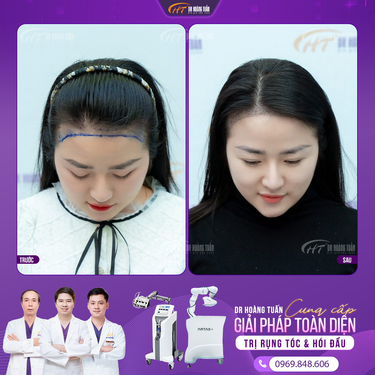 có nên cấy tóc